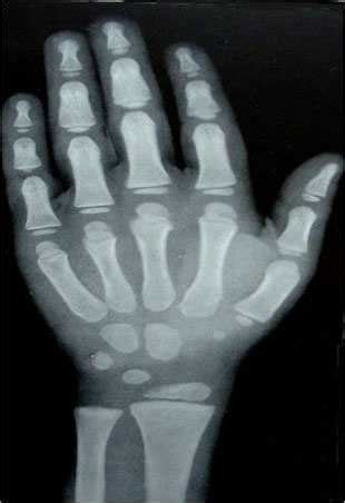 Fig3a & Fig.3b X-rays of Control and Case: Advanced bone age ...