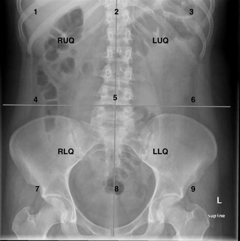 Approach to the Abdominal X-ray (AXR) – Undergraduate Diagnostic ...