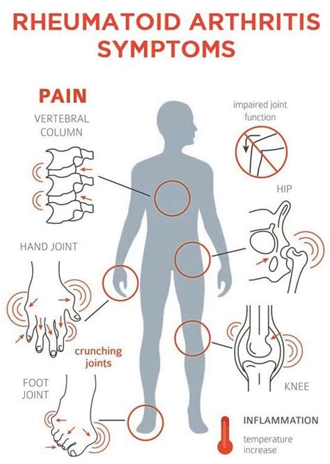 Rheumatoid Arthritis Flare-Ups Management