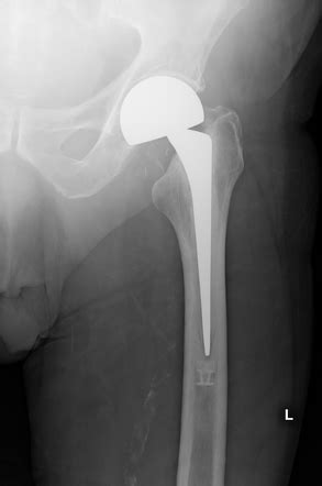 Hip arthroplasty (overview) | Radiology Reference Article | Radiopaedia.org