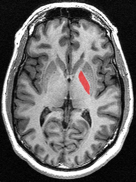 Globus pallidus