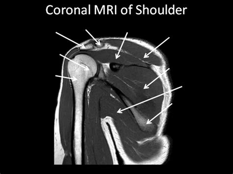 Coronal MRI of Shoulder Diagram | Quizlet