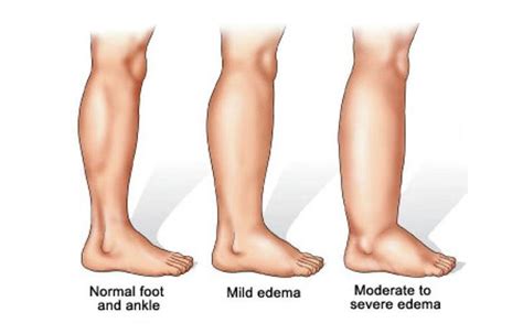 Mild Lymphedema