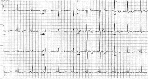 What is Wellens’ Syndrome? – Clinical Correlations