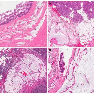 IPMN with abdominal mucin. a IPMN in the pancreas with severe cytologic ...