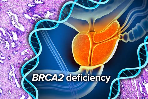 Prostate Cancer: BRCA2 deficiency | NHGRI researchers and th… | Flickr