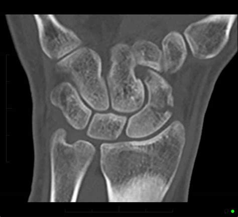 MRI for Hand and Wrist Injuries - Melbourne Radiology