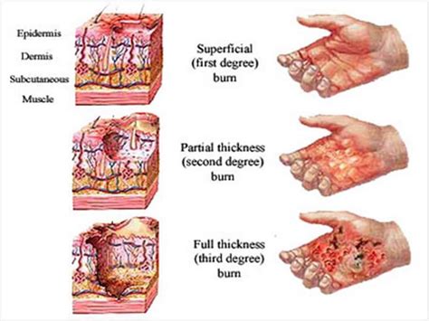 Researchers print skin cells on serious burns