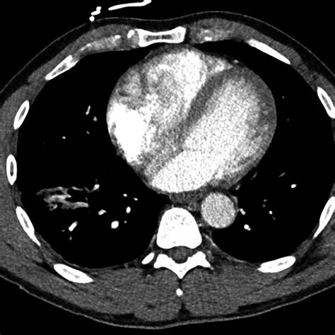 CTA chest performed as per pulmonary embolism protocol | Download Scientific Diagram