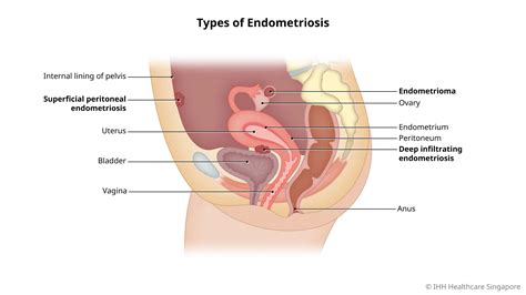 Endometriosis - Symptoms & Causes | Parkway Shenton