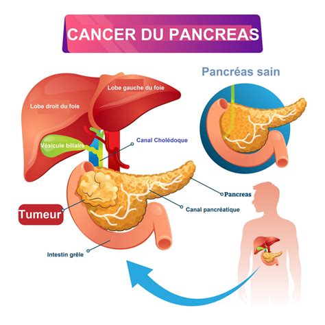 Le cancer du pancréas est-il agressif ? Quelle survie