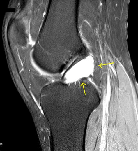 Ganglion Cyst of ACL-MRI - Sumer's Radiology Blog