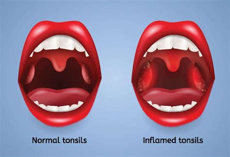 Tonsillitis