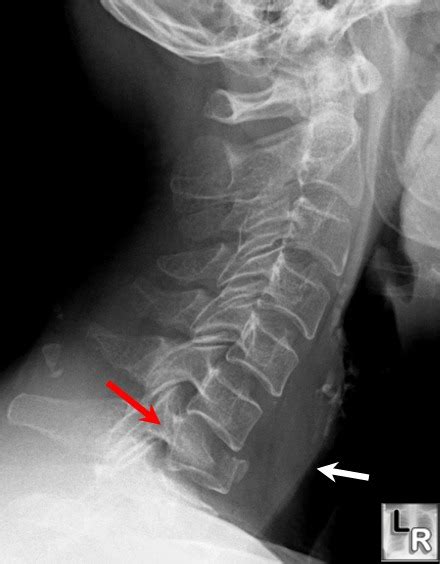 LearningRadiology.com - Burst Fracture,burst,fracture,cervical,spine,trauma