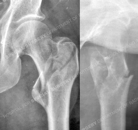 Hip Fractures - Orthopedic Trauma Service