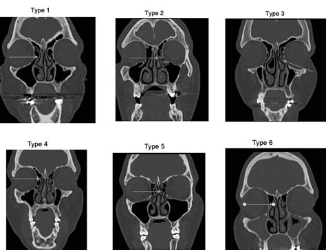 Endoscopic Anatomy Of Nose And Pns