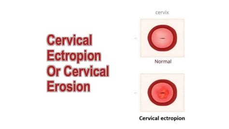 Cervical Ectropion Cervix