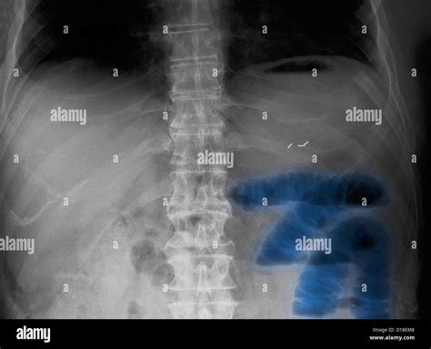 Abdominal X-ray, small bowel obstruction Stock Photo - Alamy