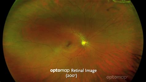 optomap Retinal Imaging - Eye Encounters