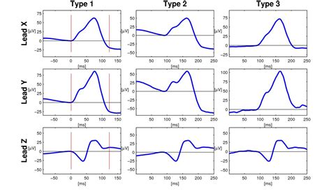 Age-related changes in P wave morphology in healthy subjects | BMC ...