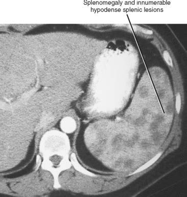 Spleen | Radiology Key