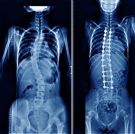 Scoliosis Surgery in NJ & NYC | Top Scoliosis Surgeons in New Jersey