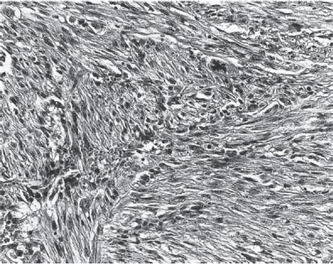 Atypical fibroxanthoma shows a proliferation of atypical spindled cells... | Download Scientific ...