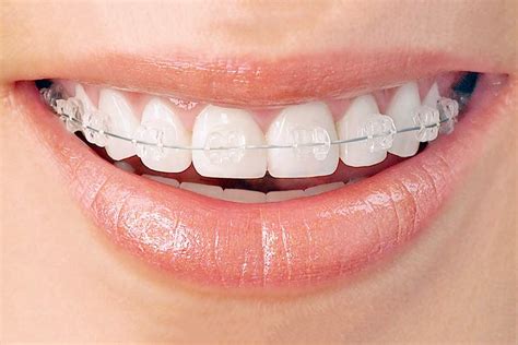 What are Ceramic Invisible Braces | Clear Braces Orthodontics Sydney