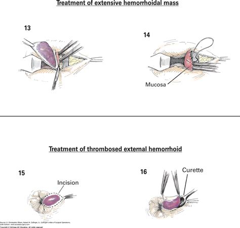 Thrombosed External Hemorrhoid Pictures / Internal & External Hemorrhoids: Top Causes & Symptoms ...