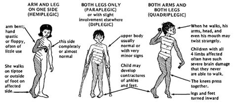 Quadriplegia medical define - Julia