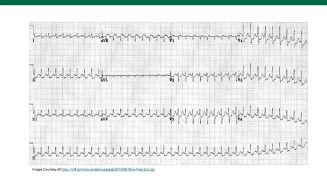 SVT on the ECG! — USF Emergency Medicine