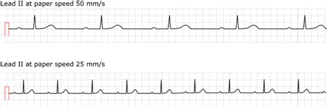 First-degree AV block (AV block I, AV block 1) – ECG learning