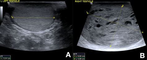 Testicular germ cell tumours | The BMJ