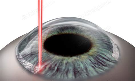 Laser limbal relaxing incisions - #SURLR0010 | Stock eye images