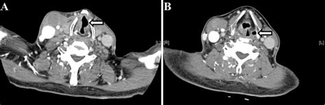 Specific signs of vocal cord palsy with (A) dilatation of the left... | Download Scientific Diagram