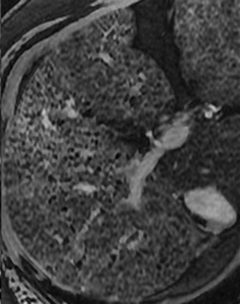 MR Imaging of Liver Fibrosis: Current State of the Art | RadioGraphics