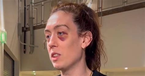 What Happened to Breanna Stewart's Eye? Injury, Explained