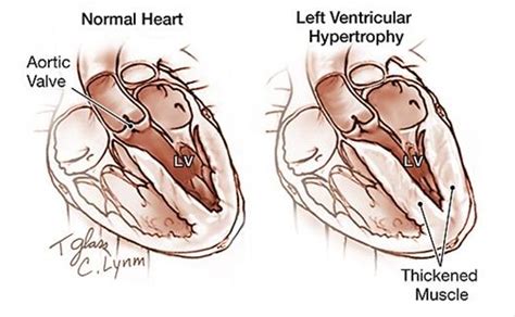 Left Ventricular Hypertrophy | MedGuidance