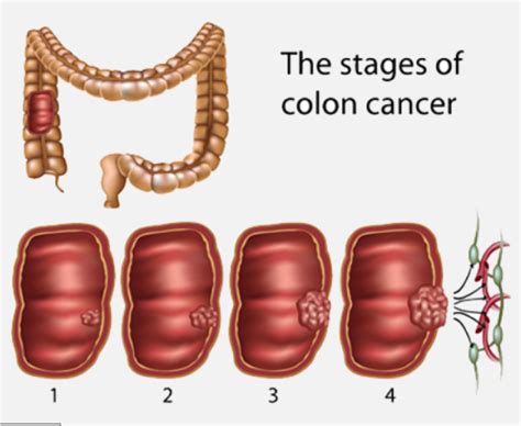 Bowel Cancer Screening - Gastrointestinal and Liver Clinic