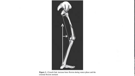 hip flexion contracture gait | Trigger points, Hips, Ortho