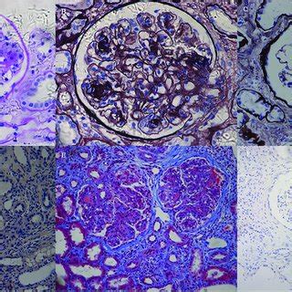 Light microscopy findings. (A) The glomerulus exhibited mesangial... | Download Scientific Diagram