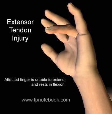 Extensor Tendon Injuries - Dr. Groh