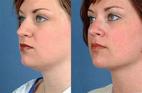 Neck Procedures Before and After Photo Gallery | Louisville & Lexington, KY | CaloAesthetics ...