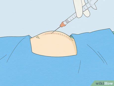 How to Help a Seroma Reabsorb & When to Seek Medical Treatment