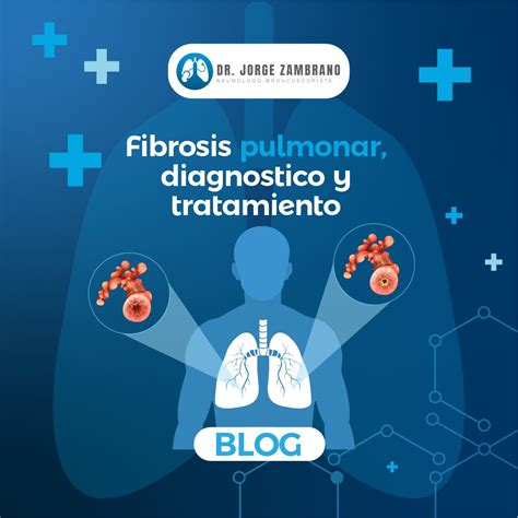 Fibrosis pulmonar, diagnostico y tratamiento - Neumólogo Dr. Zambrano