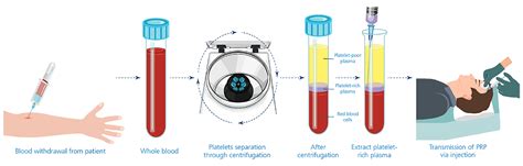 How Platelet-Rich Plasma Treatment Work | Esco Scientific