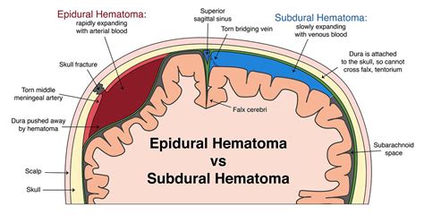 Epidural Hematoma | Epidural Hematoma Clinical Presentation