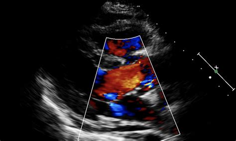 Clinical Echocardiography – Cardiovascular Education