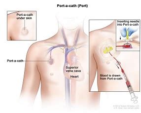 Dressing Change & Flush Port-a-Cath Instructions – MedView Systems