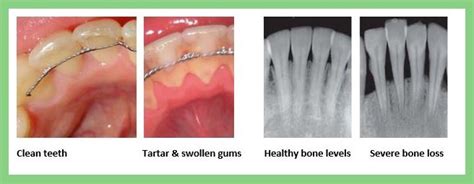 Pros and Cons of fixed retainers - 200 Front St West, Concourse